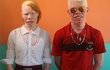 Albinos da Ilha de Maré: veja histórias dos que vivem no local com maior frequência de albinismo em Salvador (Foto: Angeluci Figueiredo/CORREIO)